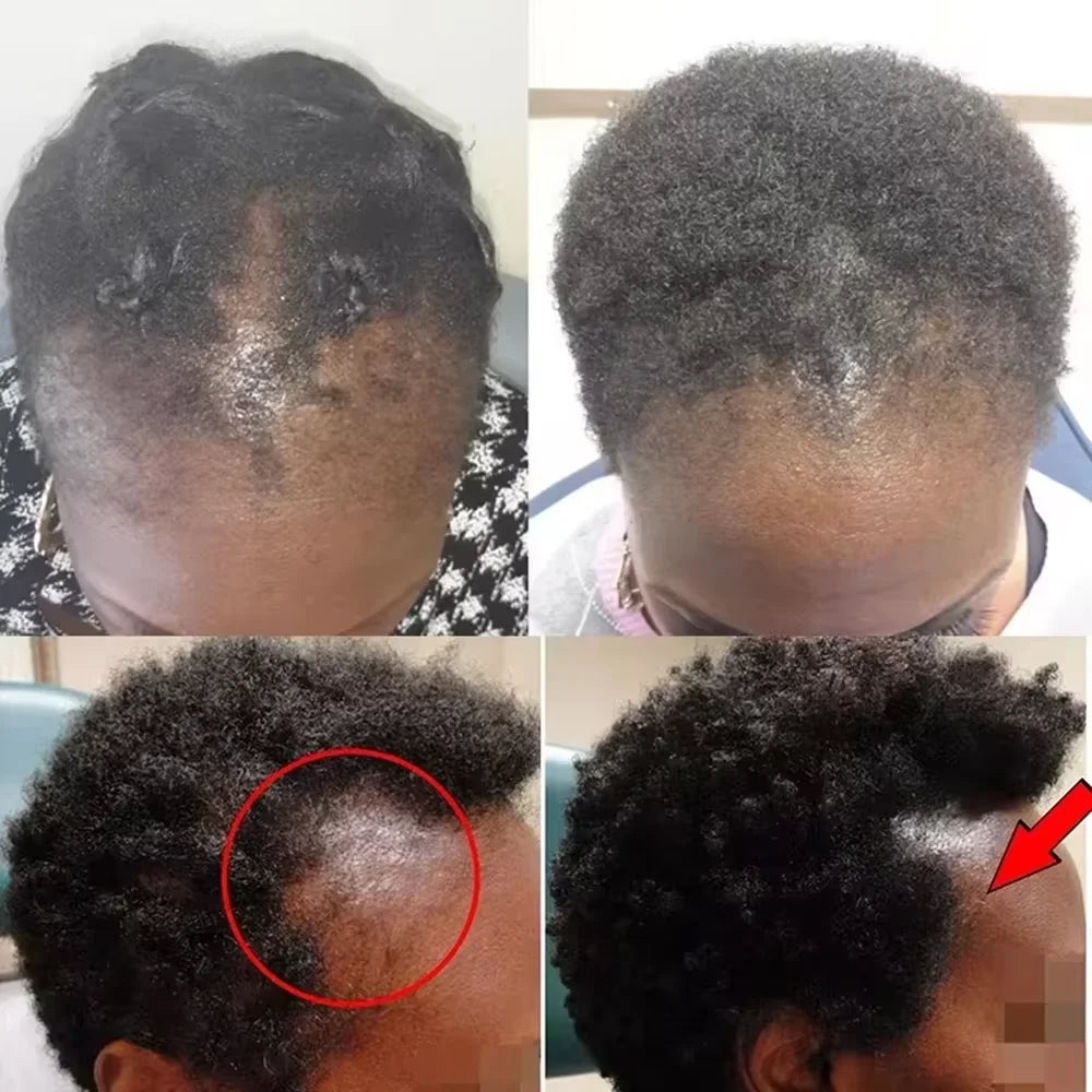 Ensemble de croissance rapide des cheveux, huile de Batana, Traction, masque capillaire d'alopécie, Anti-rupture, perte de cheveux, traitement de la calvitie, soins de santé des cheveux