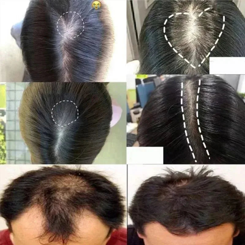 Ensemble de croissance rapide des cheveux, huile de Batana, Traction, masque capillaire d'alopécie, Anti-rupture, perte de cheveux, traitement de la calvitie, soins de santé des cheveux